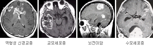 역형성 신경교종 / 교모세포종 / 뇌전이암 / 수모세포증